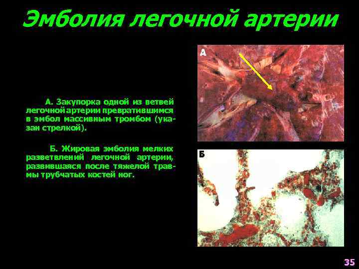 Эмболия легочной артерии А. Закупорка одной из ветвей легочной артерии превратившимся в эмбол массивным