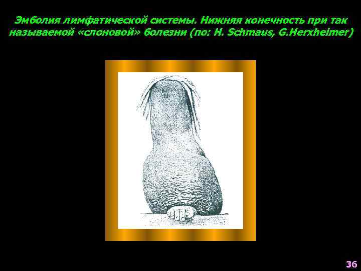 Эмболия лимфатической системы. Нижняя конечность при так называемой «слоновой» болезни (по: H. Schmaus, G.