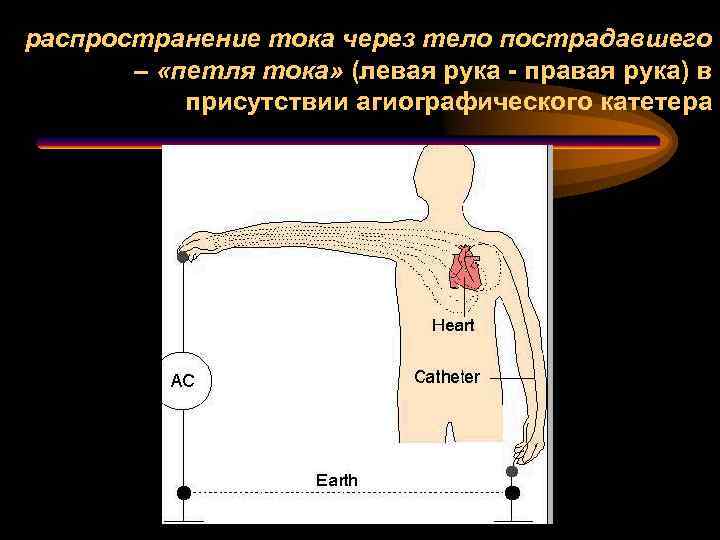 распространение тока через тело пострадавшего – «петля тока» (левая рука - правая рука) в