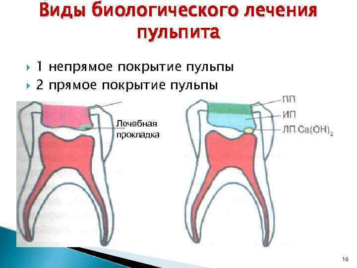 Метод витальной ампутации. Метод непрямого покрытия пульпы. Способ прямого покрытия пульпы. Биологический метод (прямое и Непрямое покрытие пульпы зуба). Метод прямого покрытия пульпы зуба.