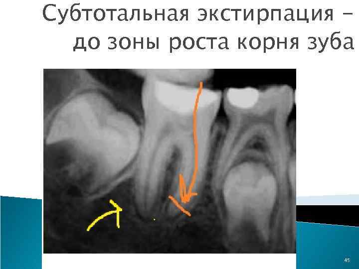 Субтотальная экстирпация до зоны роста корня зуба 45 