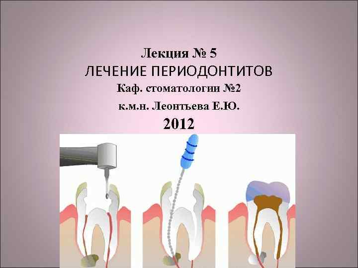 Периодонтит детская стоматология презентация