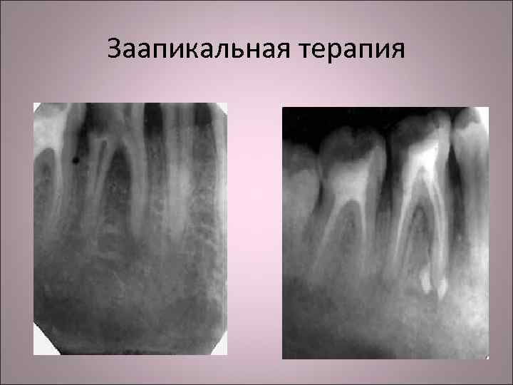 Заапикальная терапия 