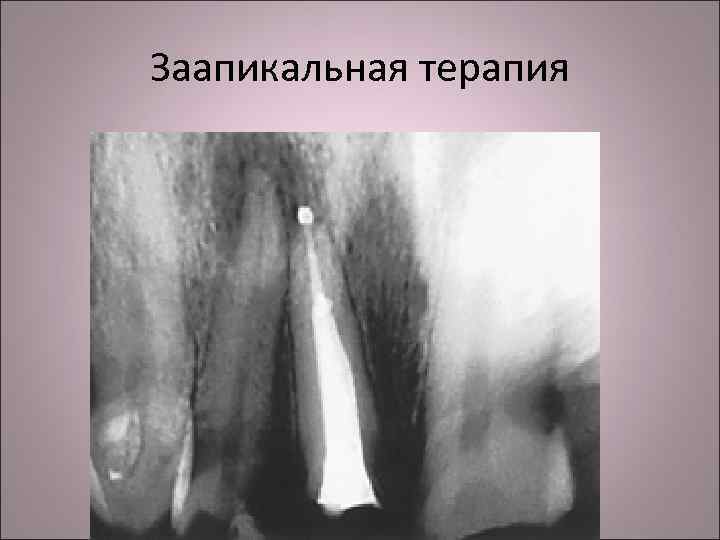 Заапикальная терапия 