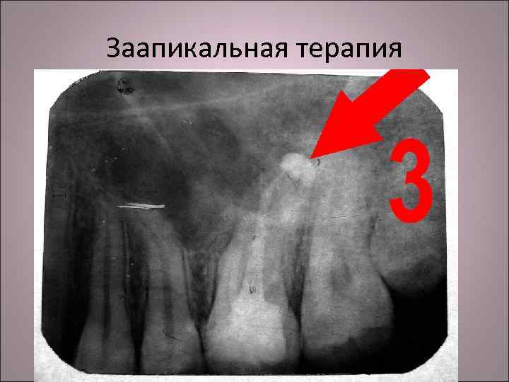 Заапикальная терапия 