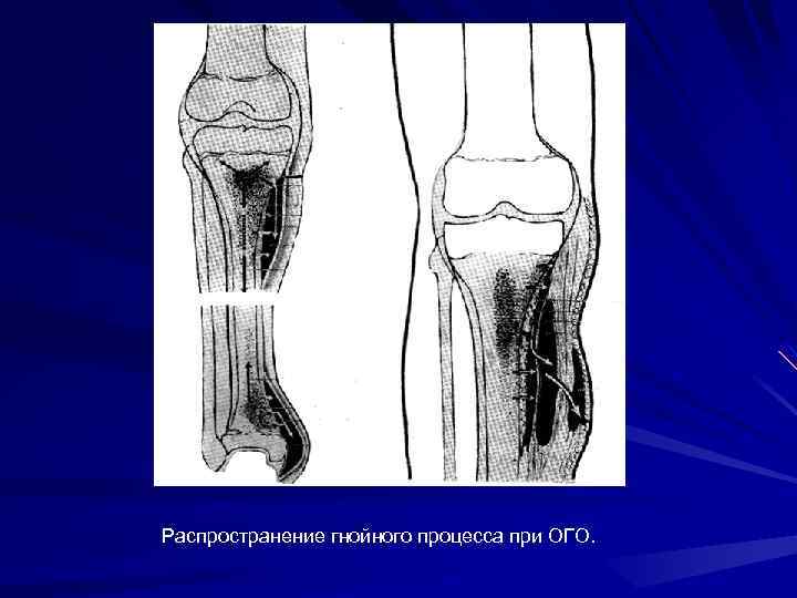 Распространение гнойного процесса при ОГО. 