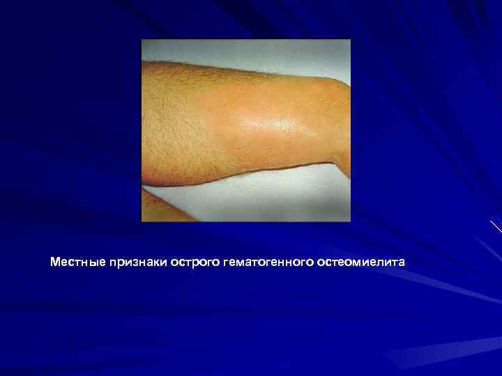 Местные признаки острого гематогенного остеомиелита 