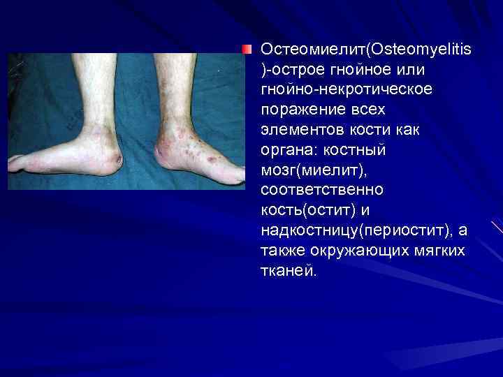 Остеомиелит(Osteomyelitis )-острое гнойное или гнойно-некротическое поражение всех элементов кости как органа: костный мозг(миелит), соответственно