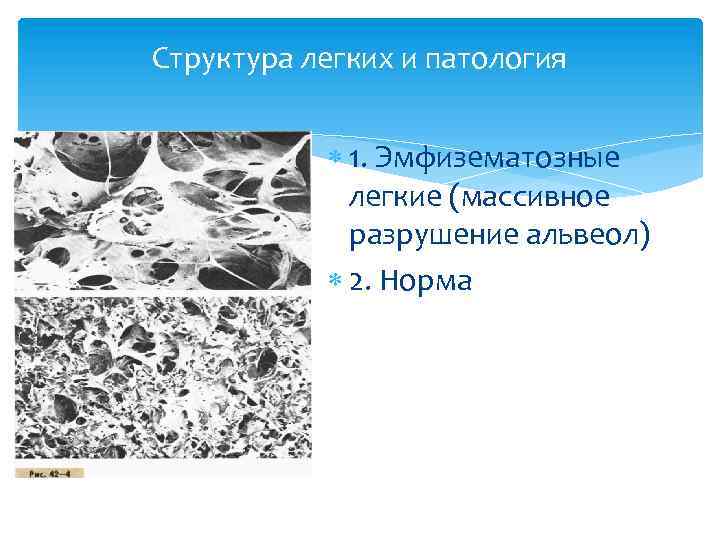 Структура легких и патология 1. Эмфизематозные легкие (массивное разрушение альвеол) 2. Норма 