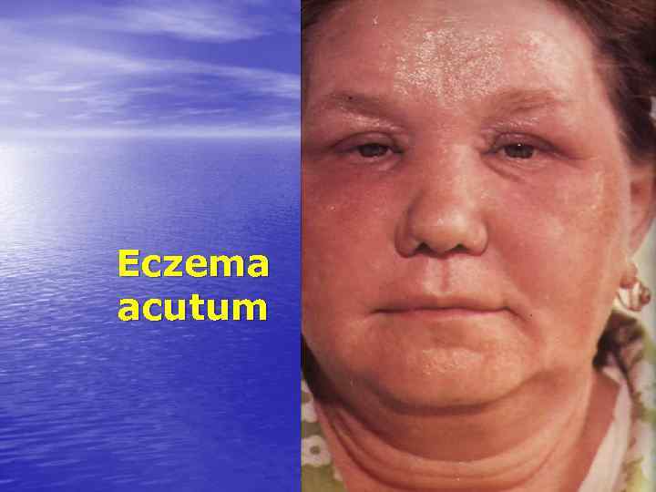 Eczema acutum 