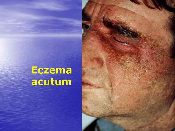 Eczema acutum 