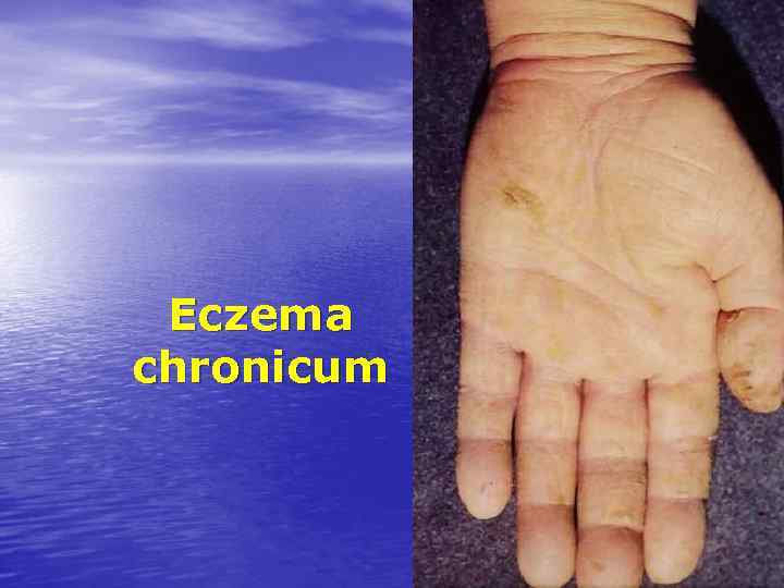 Eczema chronicum 