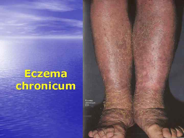 Eczema chronicum 