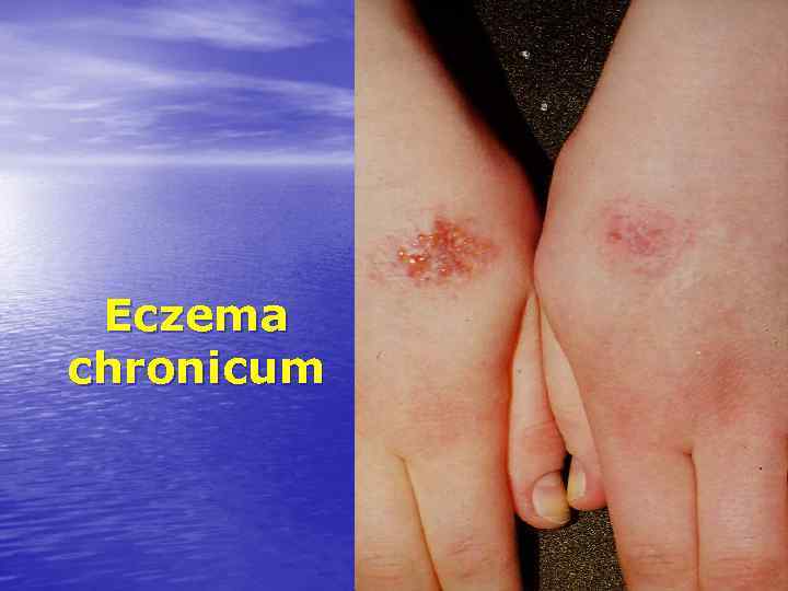 Eczema chronicum 