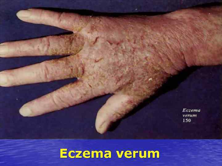 Eczema verum 