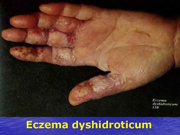 Eczema dyshidroticum 