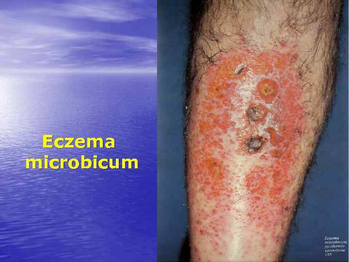 Eczema microbicum 