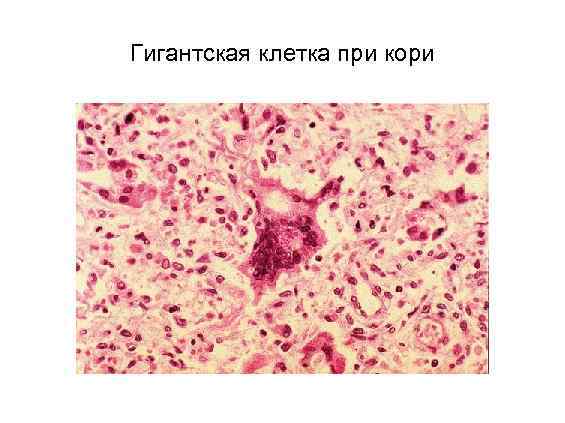 Гигантская клетка при кори 