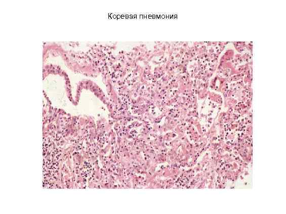 Коревая пневмония 