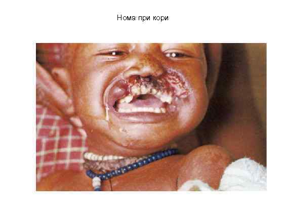 Нома при кори 