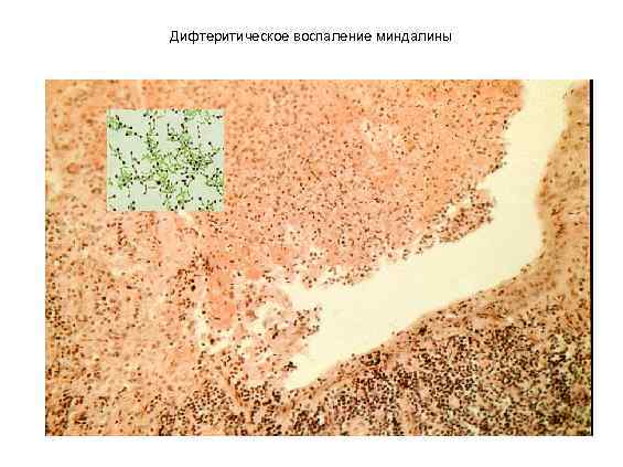 Дифтеритическое воспаление миндалины 