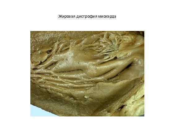 Жировая дистрофия миокарда 