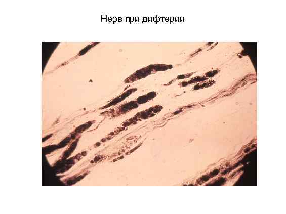 Нерв при дифтерии 