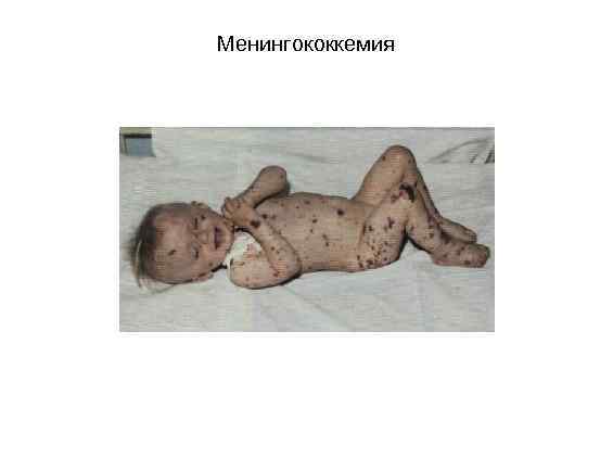 Менингококкемия 
