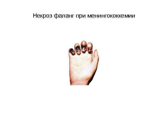 Некроз фаланг при менингококкемии 