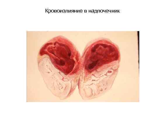 Кровоизлияние в надпочечник 