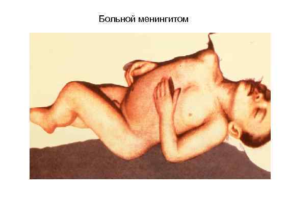 Больной менингитом 