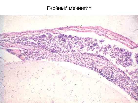 Гнойный менингит 