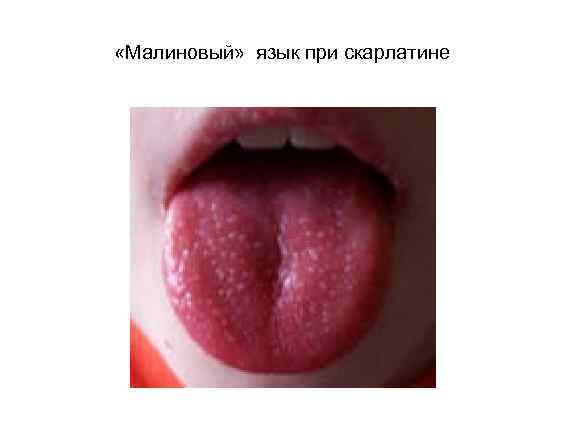  «Малиновый» язык при скарлатине 
