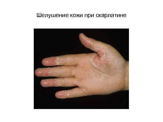 Шелушение кожи при скарлатине 