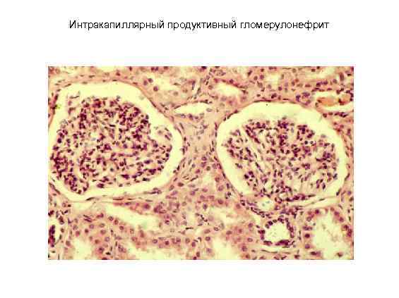 Интракапиллярный продуктивный гломерулонефрит 