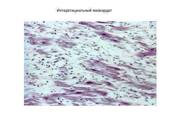 Интерстициальный миокардит 