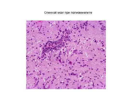Спинной мозг при полиомиелите 