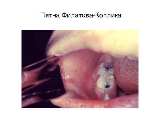 Пятна Филатова-Коплика 