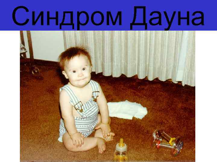 Синдром Дауна 