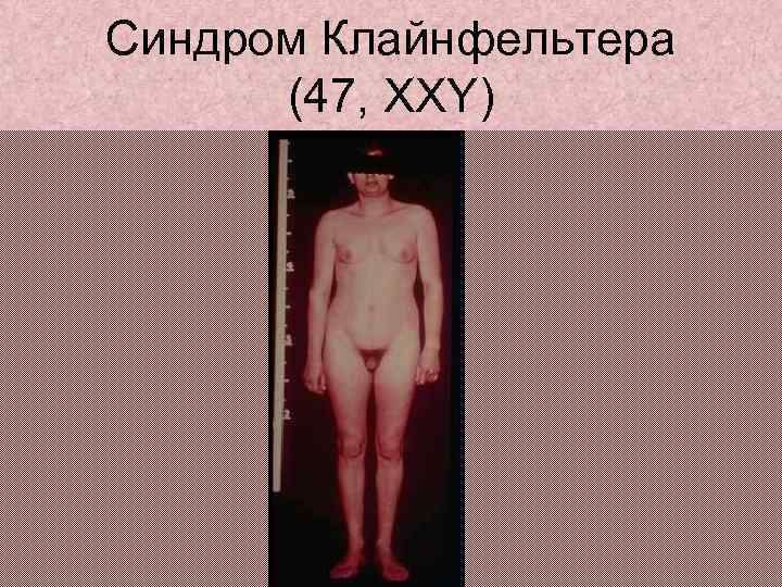 Синдром Клайнфельтера (47, XXY) 