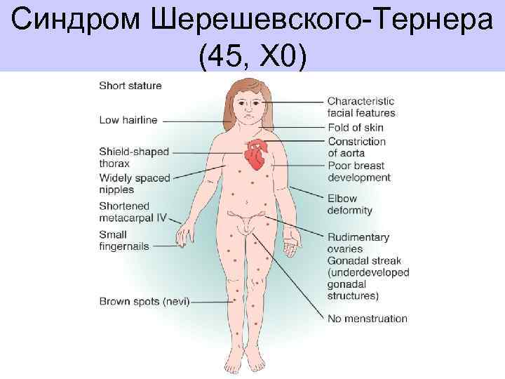 Синдром Шерешевского-Тернера (45, Х 0) 
