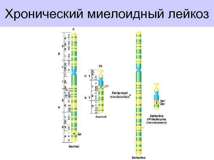 Хронический миелоидный лейкоз 