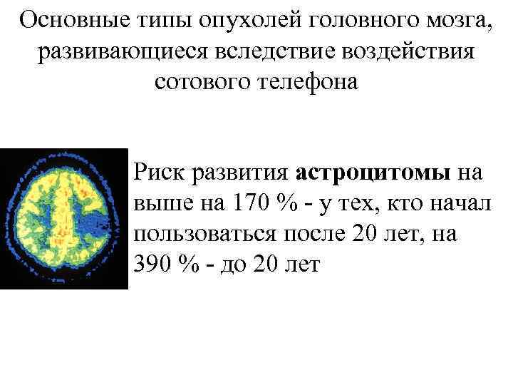 Основные типы опухолей головного мозга, развивающиеся вследствие воздействия сотового телефона Риск развития астроцитомы на