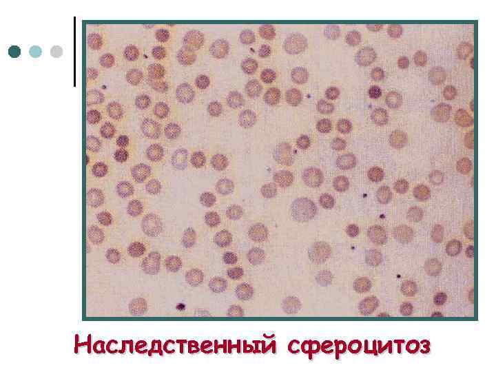 Наследственный сфероцитоз 