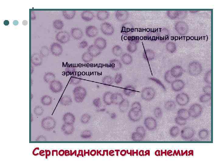 Серповидноклеточная анемия 