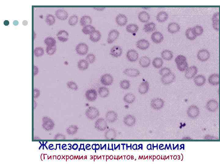 Железодефицитная анемия (Гипохромия эритроцитов, микроцитоз) 