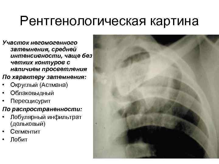 Рентгенологическая картина Участок негомогенного затемнения, средней интенсивности, чаще без четких контуров с наличием просветления