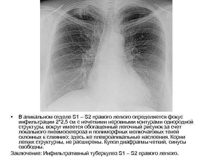  • В апикальном отделе S 1 – S 2 правого легкого определяется фокус