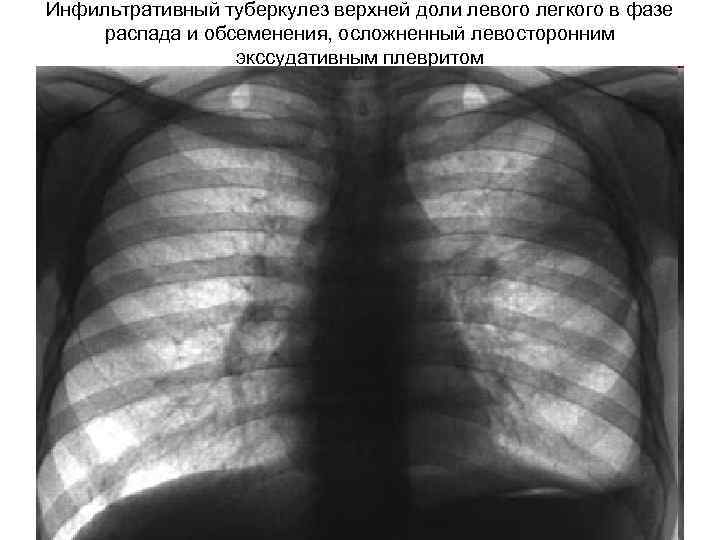 Инфильтративный туберкулез верхней доли левого легкого в фазе распада и обсеменения, осложненный левосторонним экссудативным
