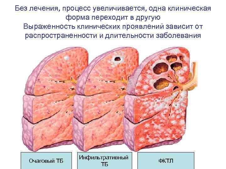 Без лечения, процесс увеличивается, одна клиническая форма переходит в другую Выраженность клинических проявлений зависит